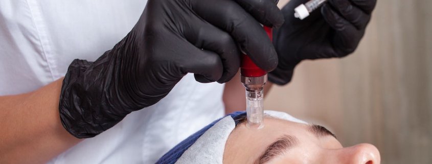 Women receiving microneedling for menopausal skin